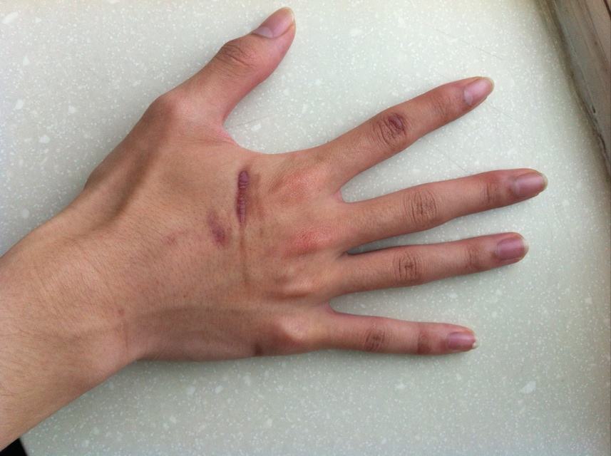 手上的疤痕看相