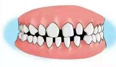 稀疏牙对今后有什么影响吗？