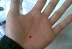 手上长痣都是幸运痣？