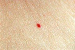 身上长红痣是怎么回事？
