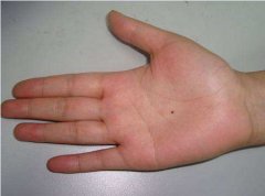 手掌有痣代表什么寓意？手掌有痣好不好？