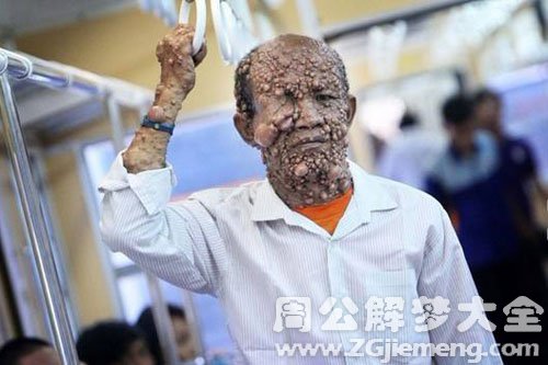 【梦见身上长满疙瘩】