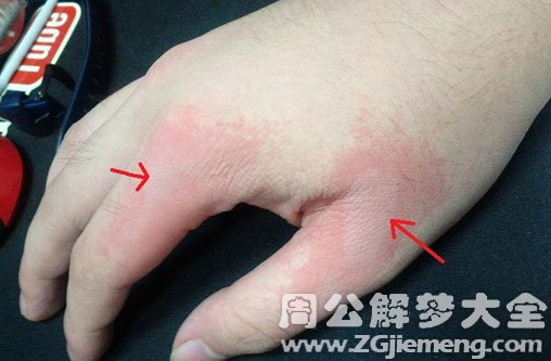 【梦见手被烫了】