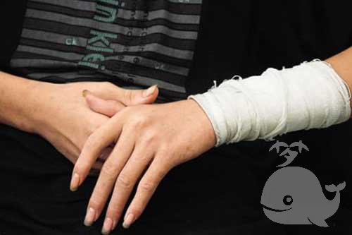 【梦见自己手臂断了】