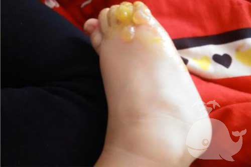 【梦见脚上长疮】