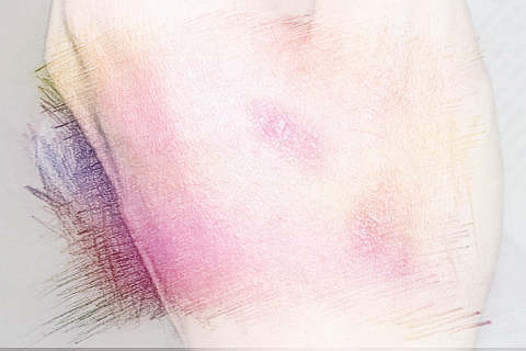 梦见被烫伤　周公解梦之梦到被烫伤