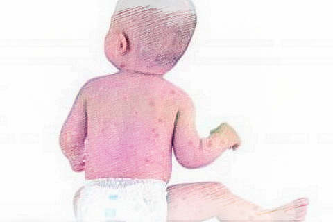 梦见出水痘　周公解梦之梦到出水痘