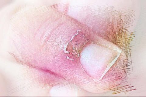 梦见手指流脓　周公解梦之梦到手指流脓