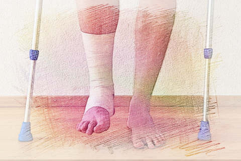 梦见脚骨折　周公解梦之梦到脚骨折