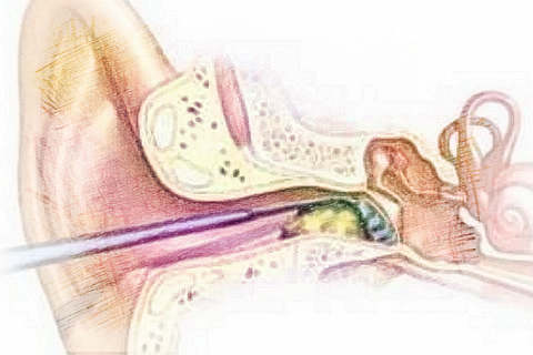 梦见很多耳屎　周公解梦之梦到很多耳屎