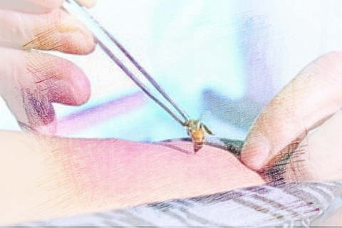 梦见被蜂蜇　周公解梦之梦到被蜂蜇