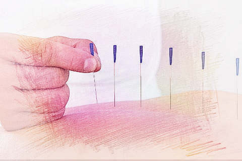 梦见针灸　周公解梦之梦到针灸