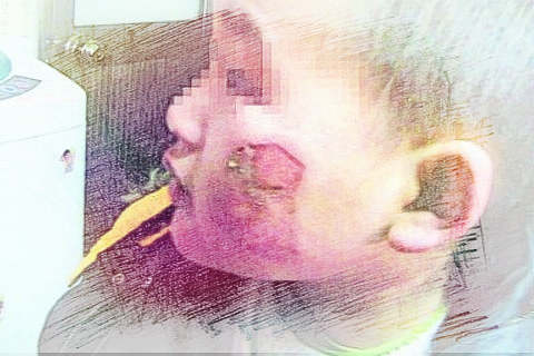 梦见脸被烧伤　周公解梦之梦到脸被烧伤