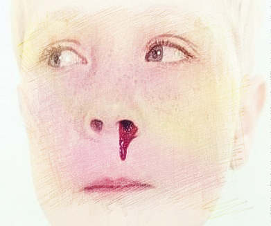 梦见鼻子滴血　周公解梦之梦到鼻子滴血