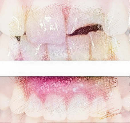 梦见牙齿断裂　周公解梦之梦到牙齿断裂