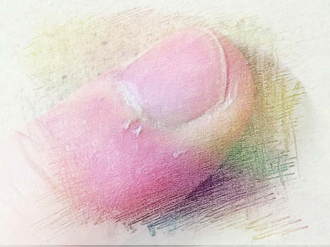 梦见手指脱皮　周公解梦之梦到手指脱皮