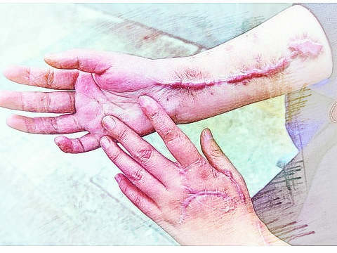 梦见手上有伤　周公解梦之梦到手上有伤