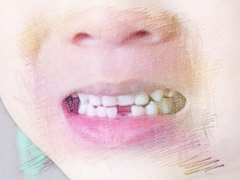 梦见拔门牙　周公解梦之梦到拔门牙