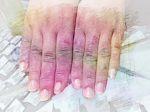 梦见手有冻疮　周公解梦之梦到手有冻疮