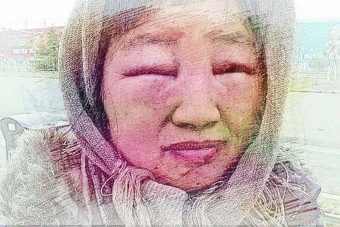 梦见双眼肿　周公解梦之梦到双眼肿