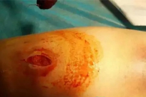 梦见腿烂了　周公解梦之梦到腿烂了