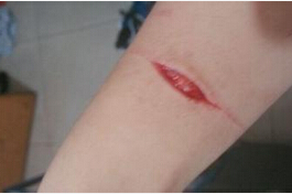 梦见老公受伤流血