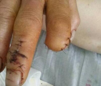 做梦梦见亲人手指断了