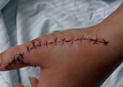 梦见自己被刀砍