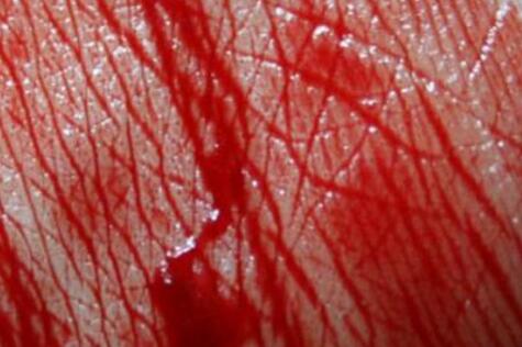 梦见自己一身血