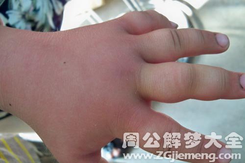 【梦见手肿】